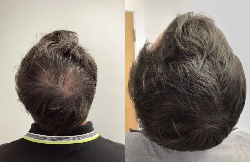 hair loss treatment vizag visakhapatnam hair tranplant prp