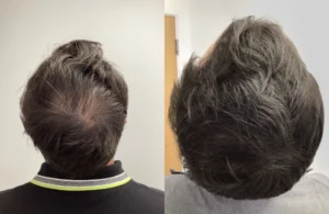 hair loss treatment vizag visakhapatnam hair tranplant prp