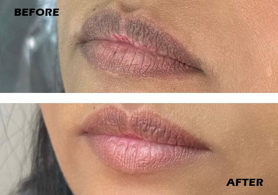lip pigmentation treatment vizag